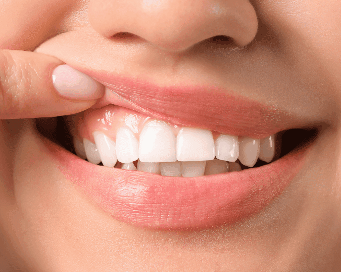 Estética gengival em Joinville - Prodentex